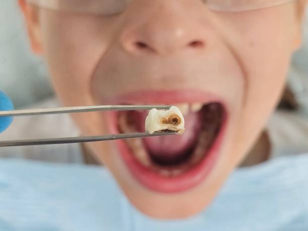 Best Emergency Dentist for Knocked-Out Tooth in Narberth, PA